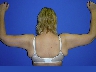 Arm Lift