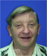 Eyelid Surgery (Blepharoplasty)