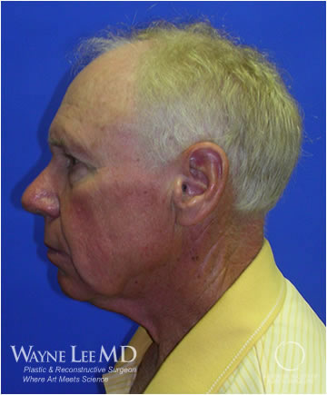 Necklift Case 215 Before Photo Necklift