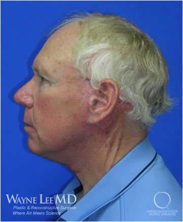 Necklift Case 215 After Photo Necklift