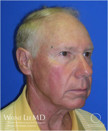 Necklift Case 215 Before Photo Necklift