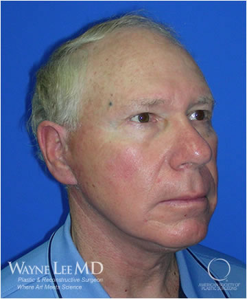 Necklift Case 215 After Photo Necklift