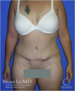 Tummy Tuck