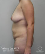 Tummy Tuck