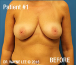 Mastopexy (Breast Lift)