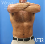CoolSculpting