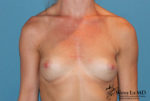 Breast Revision Results Tampa