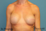 Breast Reconstruction