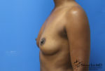 Breast Augmentation