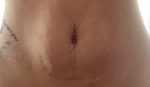 TempSure