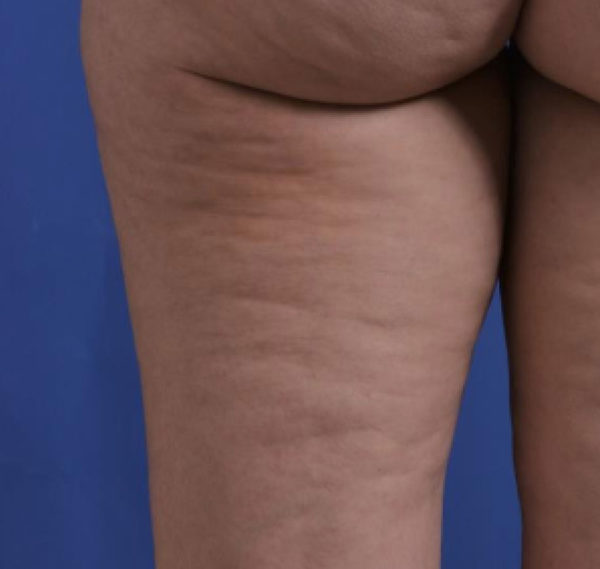 TempSure Case 998 Before Photo TempSure