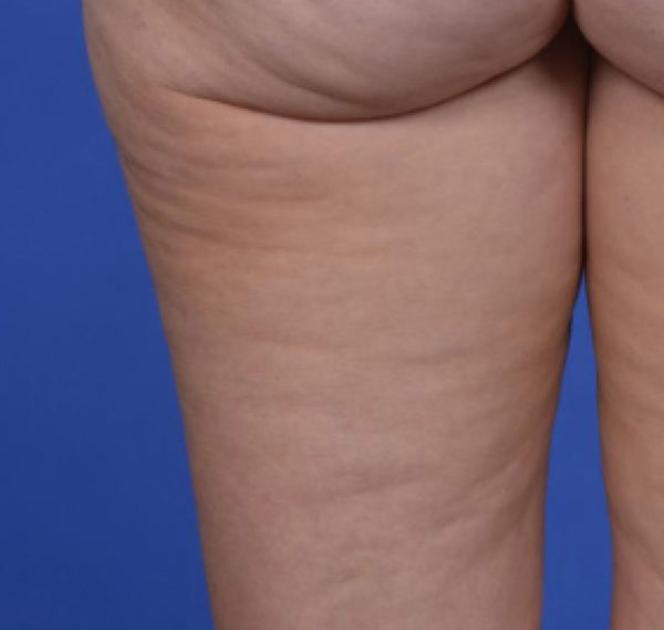 TempSure Case 998 After Photo TempSure
