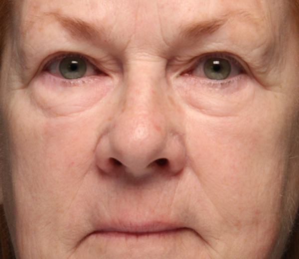 AccuTite Case 1537 Before Photo AccuTite