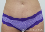 Morpheus8